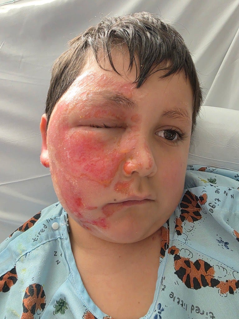 Despite his face being burnt, Caleb's eye was unharmed.