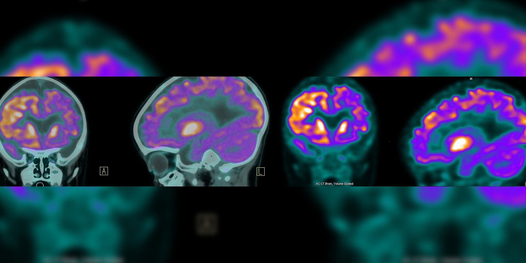 PET (positron emission tomography) scan of the brain