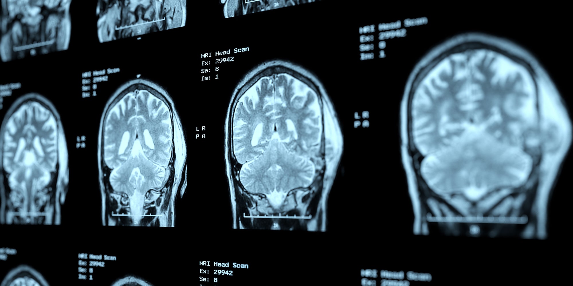 MRI results of brain scan