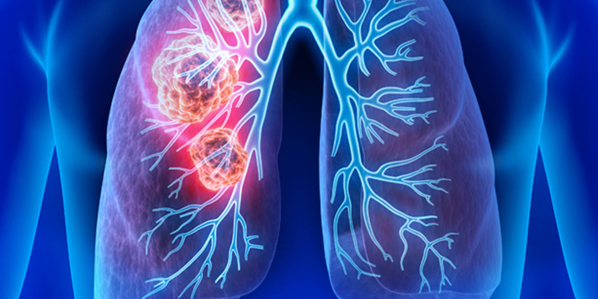 November is Lung Cancer Awareness Month