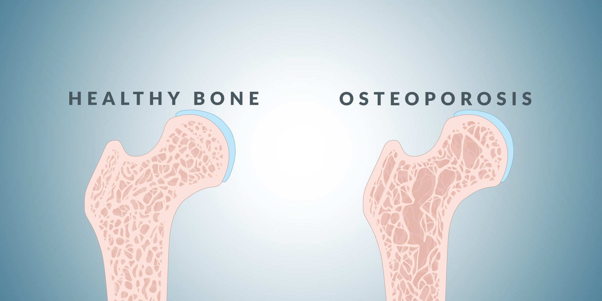 Healthy bone and bone with osteoporosis