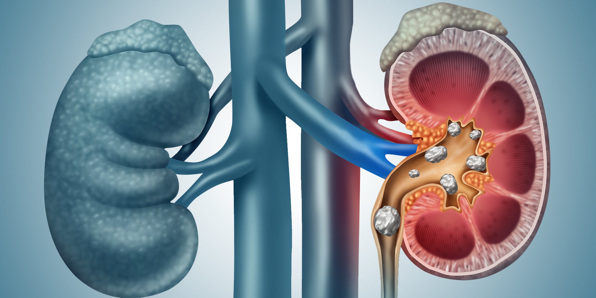 Illustration of kidney stones in the kidneys